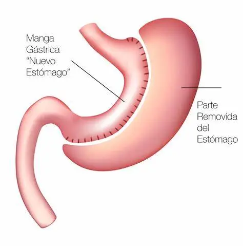 Diagrama de la cirugía de manga gástrica mostrando la parte removida del estómago.