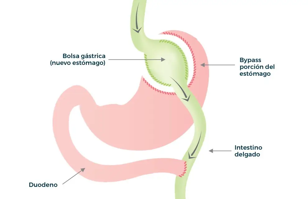 Diagrama del bypass gástrico mostrando el nuevo estómago y el intestino delgado.